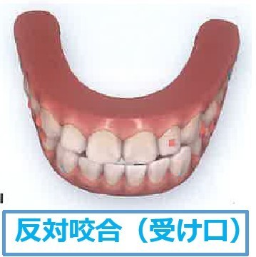 反対咬合