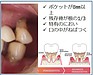 歯を抜くという選択について