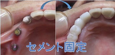 インプラント上部構造が「生涯、仮着」であることの深遠な理由