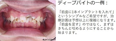 インプラントで「後悔」する人と「満足」する人の決定的な違い