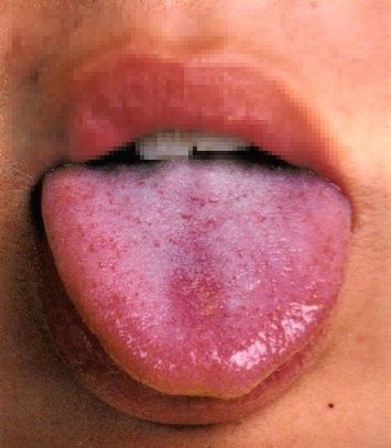 舌診