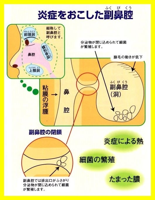 鼻淵丸　鼻炎　鼻づまり