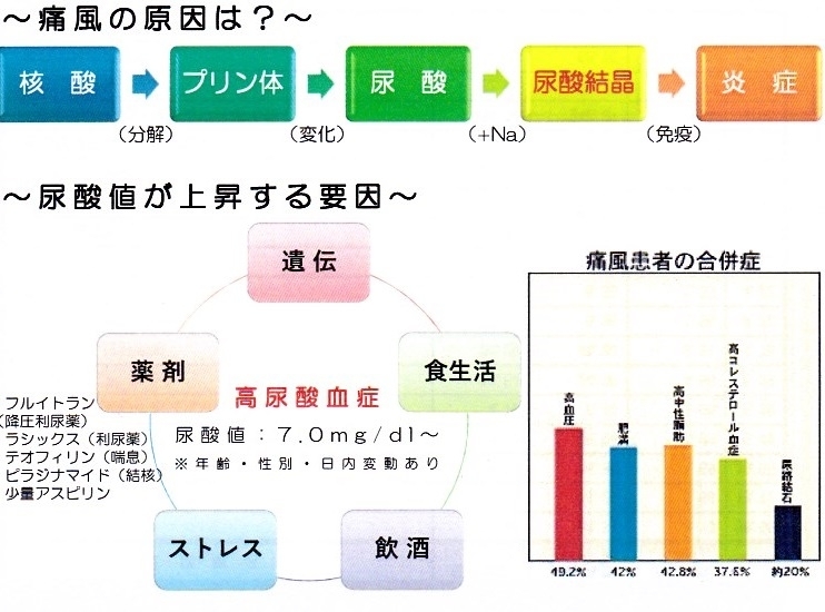 痛風　発作