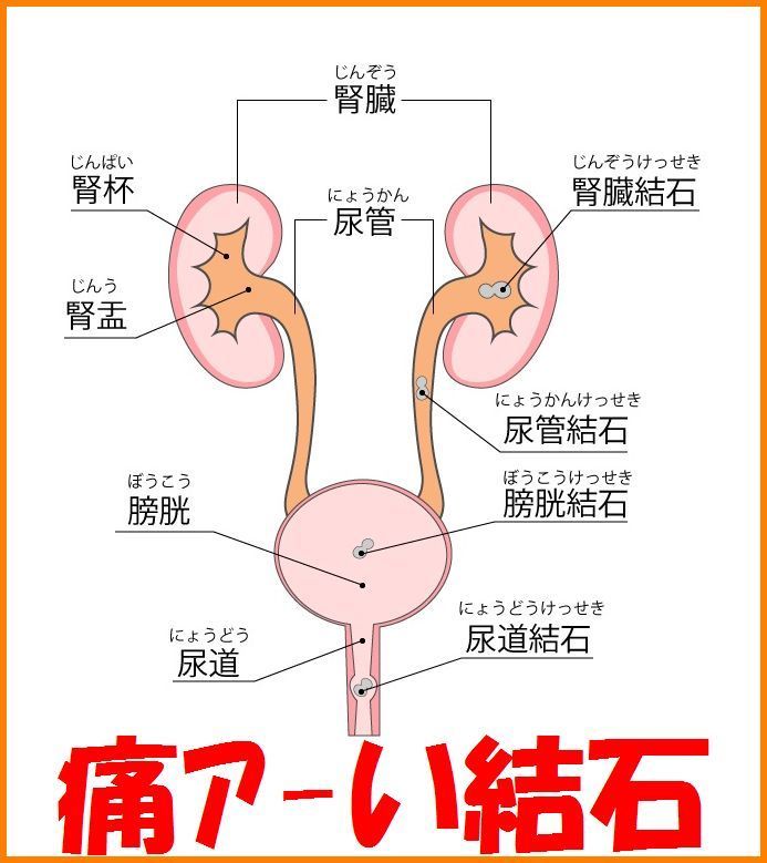 結石　スクアレン　漢方薬　五淋散