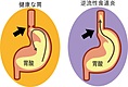 慢性の逆流性食道炎が楽になりました