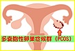 多嚢胞性卵巣症候群（PCOS）と茸エキス