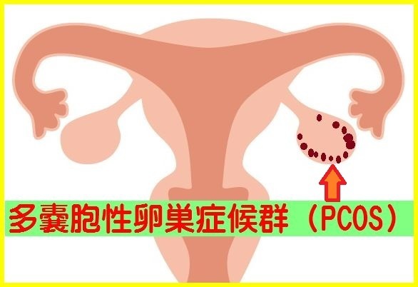 多嚢胞性卵巣症候群（PCOS）