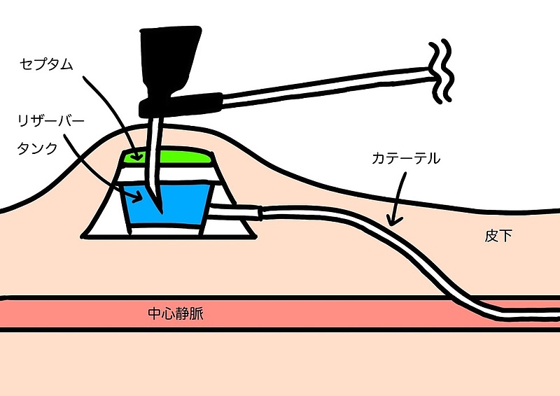 ガン　cvポート