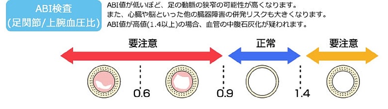 ABI(足関節上腕血圧比)