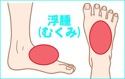 ココの浮腫(むくみ)の一因は・・・？