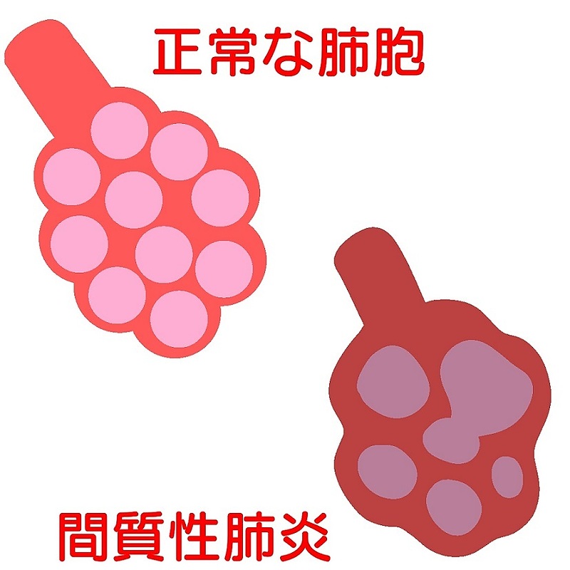 衛益顆粒　肺炎