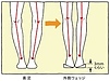 膝の痛み　〜変形性膝関節症②〜