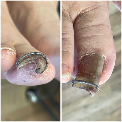 巻き爪　〜長年の悩み〜