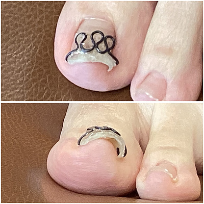 巻き爪のお悩み