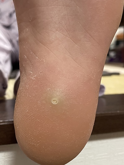 足の裏のイボへの対応