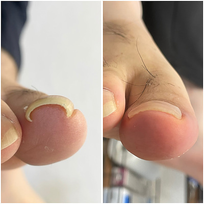 巻き爪のお悩み