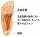 足底筋（腱）膜炎　その１