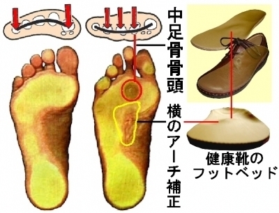 中足骨骨頭部痛 ちゅうそつこつこっとうぶつう シューフィッター 小黒健二 マイベストプロ神奈川