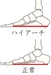 ハイアーチによる甲高と足裏の角質