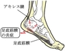 足底腱膜炎、踵骨棘の痛みを庇って、中足骨骨頭痛になる