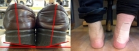 膝の痛みを助長する靴と外反母趾や扁平足を助長する靴