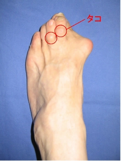 足 の 指 関節 タコ