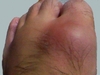 左足親指の付け根の腫れ