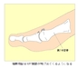 強剛母指による足の腫れと痛み