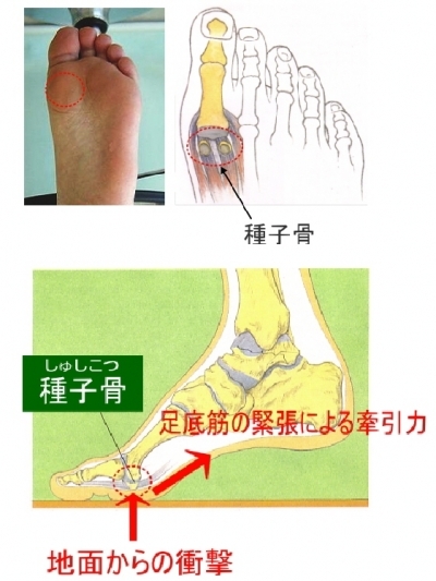 親指の付け根にある種子骨の炎症 シューフィッター 小黒健二 マイベストプロ神奈川
