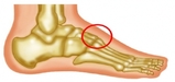 足の甲の腫れ