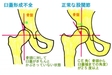 先天性臼蓋形成不全と健康靴