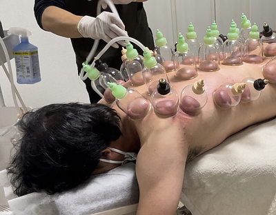 「知らないのはもったいない！世界のアスリートが信頼を寄せる『吸玉（カッピング）』の本当の魅力」〜世界のアスリートからデスクワークの疲れまで〜