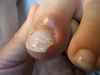 巻き爪仙台・化膿などの痛みは巻き爪だけの問題ではないことも・・・