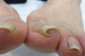仙台巻き爪矯正院・巻き爪と外反母趾は関連性がある？！