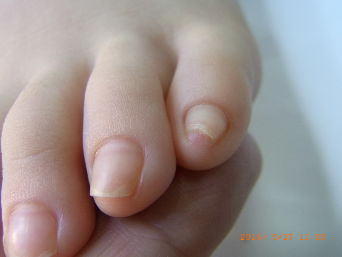 巻き爪仙台 ５歳の足の小指の痛みが 整体師 寺建文夫 マイベストプロ宮城