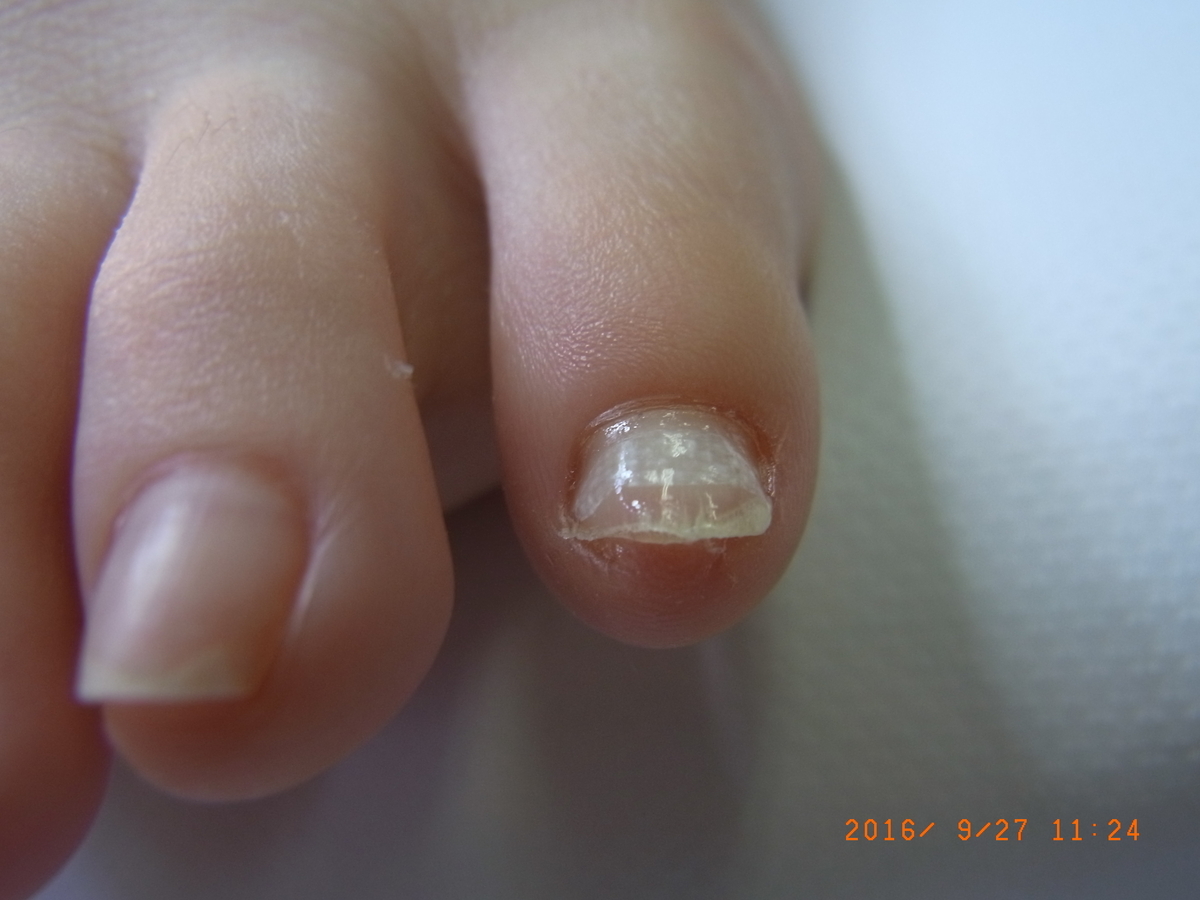 巻き爪仙台 ５歳の足の小指の痛みが 整体師 寺建文夫 マイベストプロ宮城