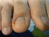 巻き爪仙台・痛い陥入爪の対処方法（症例画像）