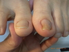 仙台巻き爪症例・陥入爪４回の矯正後の画像
