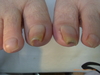 仙台巻き爪・重度の巻き爪６回の矯正、症例画像あり