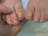 仙台巻き爪・痛い陥入爪の症例（画像あり）