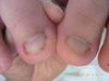 仙台巻き爪・超深爪の陥入爪の症例画像