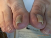 仙台巻き爪・陥入爪の症例 二回の施術後画像あり