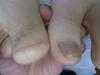 仙台巻き爪・巻き爪で化膿悪化で指先失う？