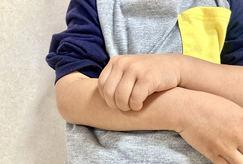 花粉症皮膚炎子供