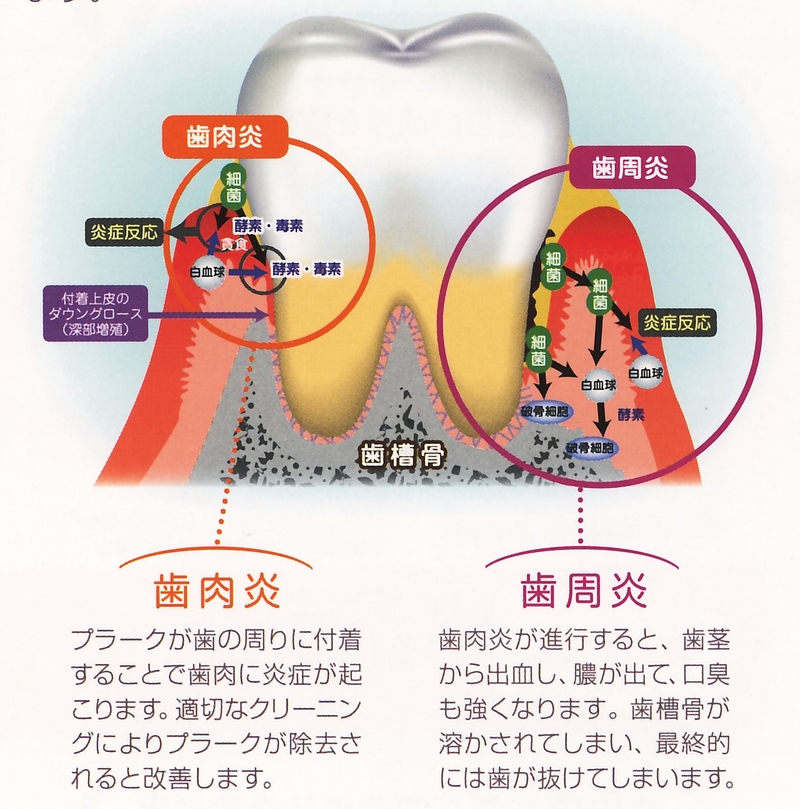 歯周病