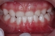歯列不正や不正咬合と遺伝との関係