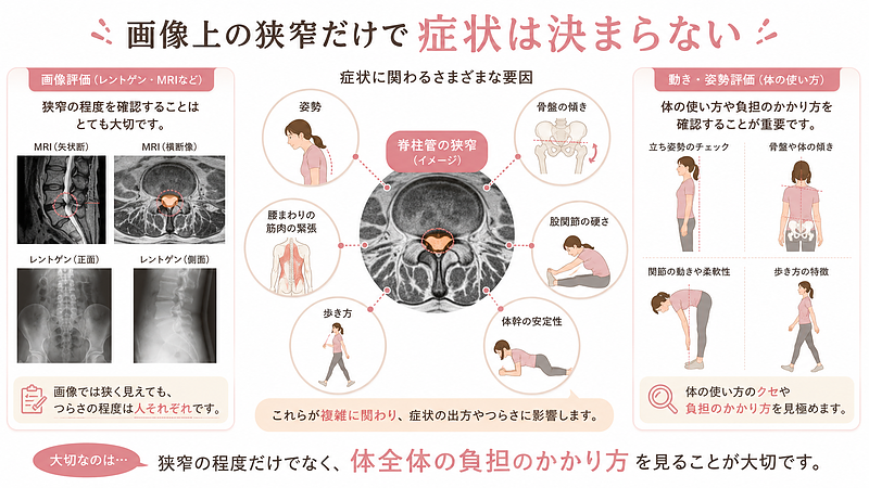 脊柱管狭窄症の症状は、MRIやレントゲンで見える狭窄の程度だけで決まるわけではないことを示した図解です。姿勢、骨盤の傾き、股関節の硬さ、歩き方、腰まわりの筋肉の緊張、体幹の安定性など、体全体の負担のかかり方が症状に関係することを表現しています。