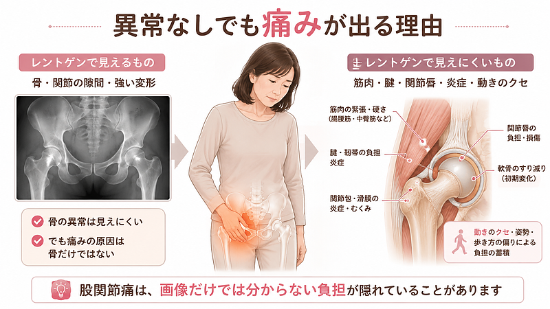 病院でレントゲン検査を受けて「異常なし」と言われた股関節痛でも、筋肉・腱・関節唇・炎症・動きのクセなど、画像だけでは分かりにくい原因が隠れていることがあります。股関節痛を骨だけで判断せず、周囲組織や体の使い方まで確認する大切さを解説した専門図解です。 病院でレントゲン検査を受けて「異常なし」と言われた股関節痛でも、筋肉・腱・関節唇・炎症・動きのクセなど、画像だけでは分かりにくい原因が隠れていることがあります。股関節痛を骨だけで判断せず、周囲組織や体の使い方まで確認する大切さを解説した専門図解です。