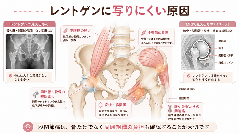股関節痛の原因は、レントゲンに写る骨の異常だけではありません。腸腰筋の硬さ、中臀筋の負担、関節唇や軟骨の初期変化、炎症、腰や骨盤からの関連痛など、股関節まわりの組織や動きの問題を分かりやすく整理した医学図解です。 股関節痛の原因は、レントゲンに写る骨の異常だけではありません。腸腰筋の硬さ、中臀筋の負担、関節唇や軟骨の初期変化、炎症、腰や骨盤からの関連痛など、股関節まわりの組織や動きの問題を分かりやすく整理した医学図解です。