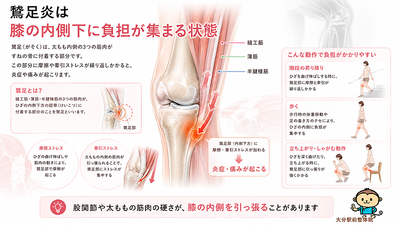 鵞足炎によって膝の内側下に痛みが出る仕組みを解説した専門図解です。縫工筋・薄筋・半腱様筋が膝の内側に付着する構造を示し、太ももや股関節まわりの筋肉の硬さが膝の内側を引っ張り、摩擦や牽引ストレスによって痛みにつながることを分かりやすく表現しています。 鵞足炎によって膝の内側下に痛みが出る仕組みを解説した専門図解です。縫工筋・薄筋・半腱様筋が膝の内側に付着する構造を示し、太ももや股関節まわりの筋肉の硬さが膝の内側を引っ張り、摩擦や牽引ストレスによって痛みにつながることを分かりやすく表現しています。